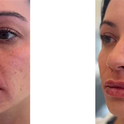 lip fillers