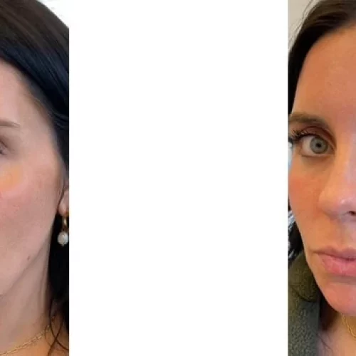 best fillers for face