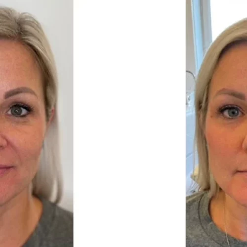 dermal fillers