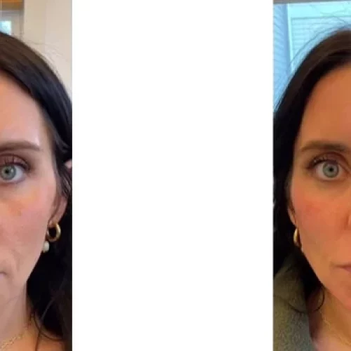 best fillers for face
