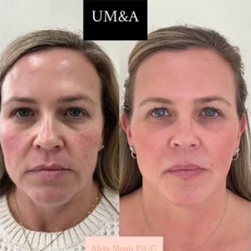 Dermal in Wilmington, NC | United Medical And Aesthetics