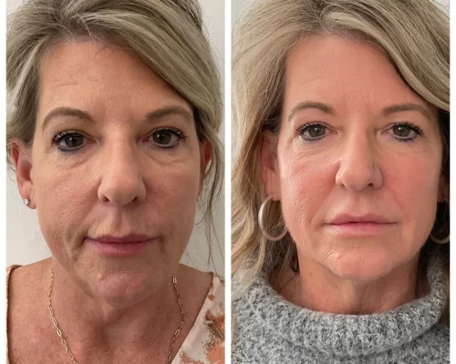 microneedling facial