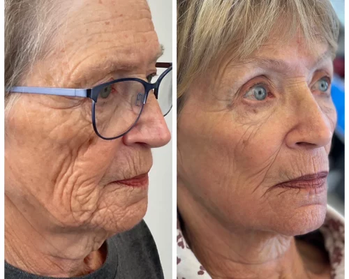 microneedling facial