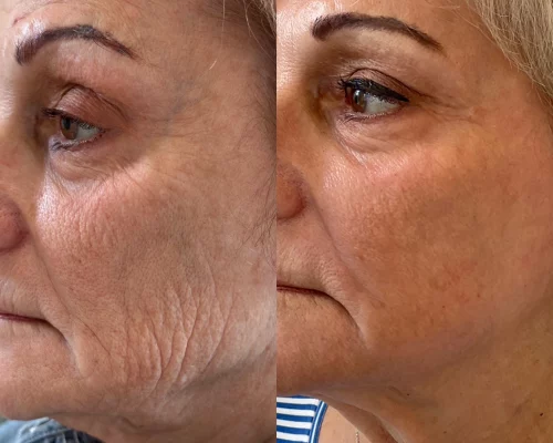 microneedling facial