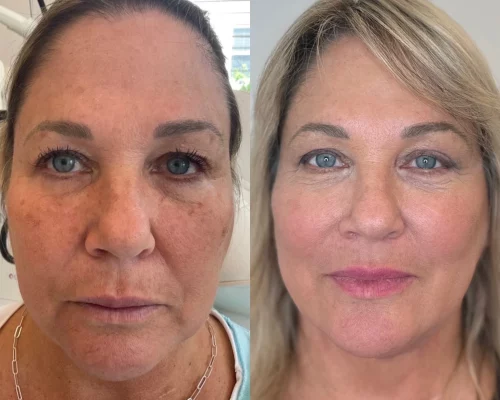 Botox wilmington nc