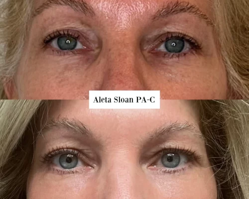 microneedling facial