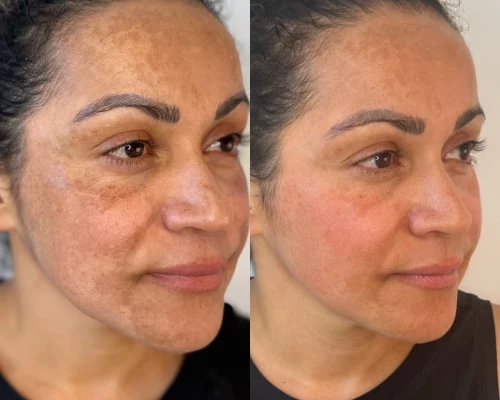 Botox
