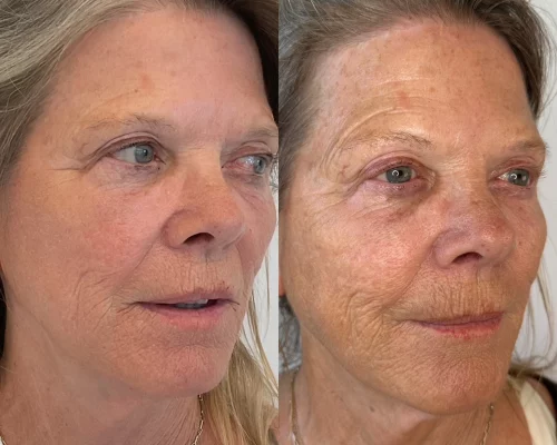 best fillers for face