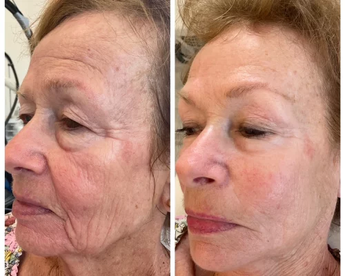 microneedling facial