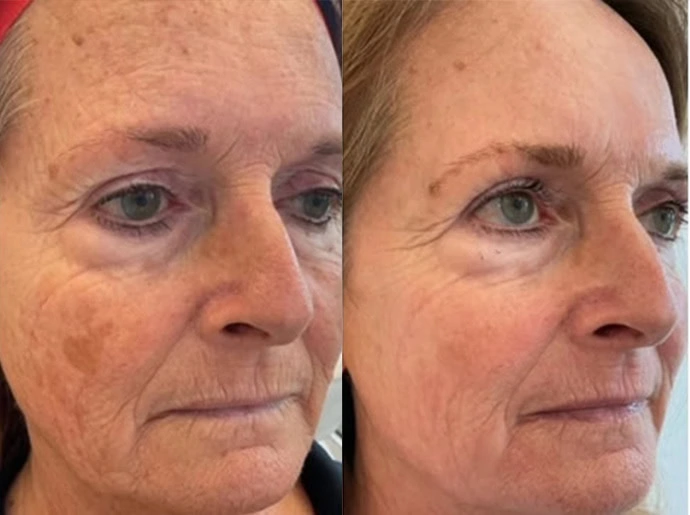 CO2 Laser Resurfacing in Wilmington, NC at United Medical And Aesthetics