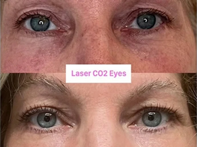 CO2 Laser Resurfacing in Wilmington, NC at United Medical And Aesthetics