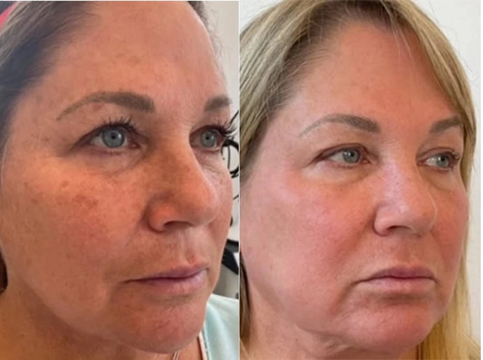 CO2 Laser Resurfacing in Wilmington, NC at United Medical And Aesthetics
