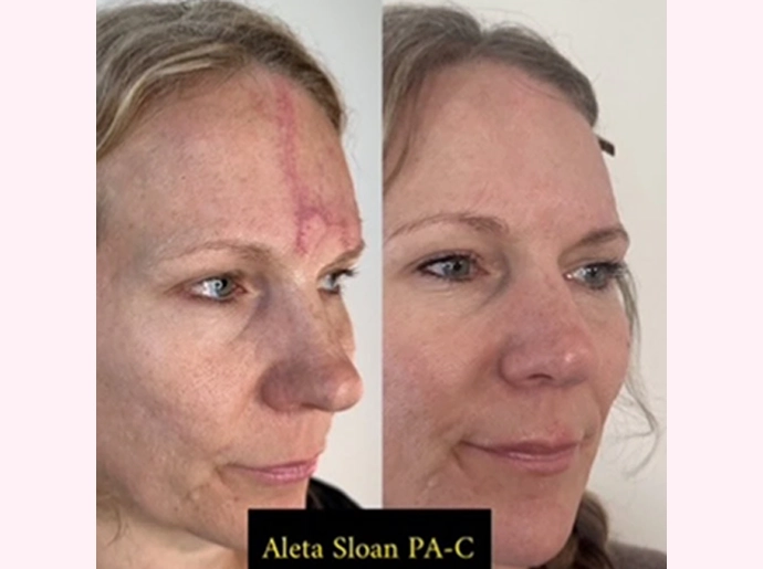 CO2 Laser Skin Resurfacing Treatment in Wilmington, NC