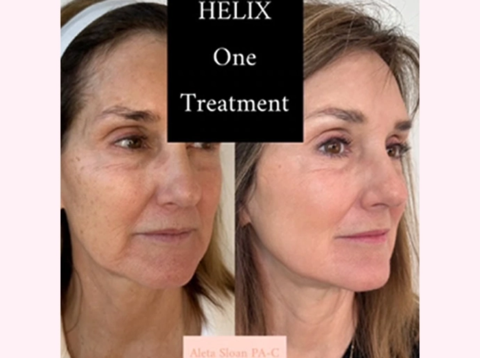 CO2 Laser Skin Resurfacing Treatment in Wilmington, NC