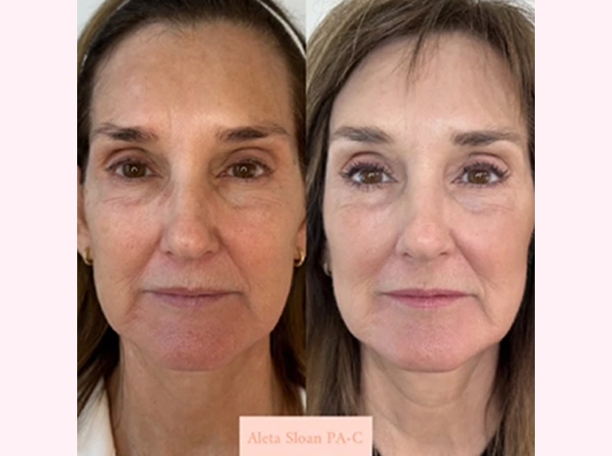 CO2 Laser Skin Resurfacing Treatment in Wilmington, NC