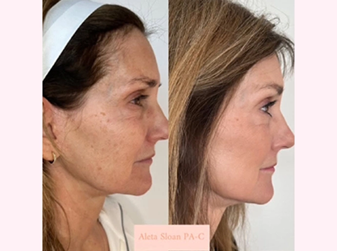CO2 Laser Skin Resurfacing Treatment in Wilmington, NC