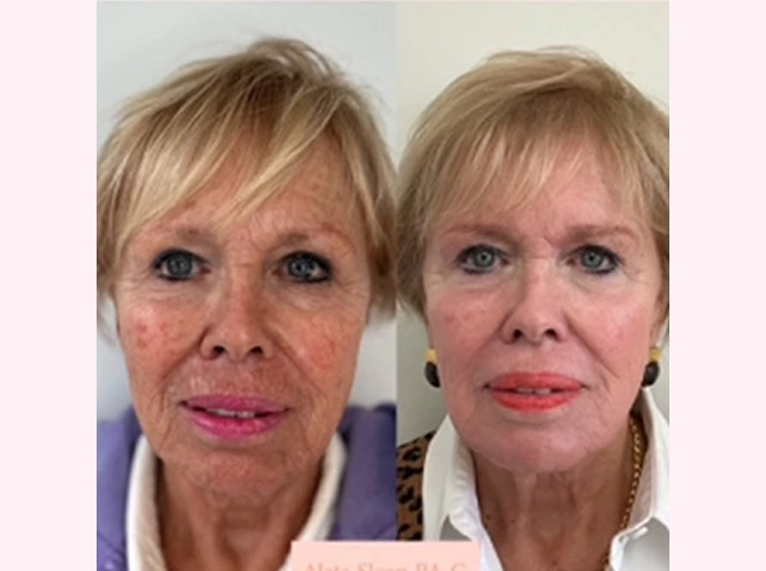 CO2 Laser Skin Resurfacing Treatment in Wilmington, NC