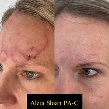 CO2 Laser Skin Resurfacing Treatment in Wilmington, NC
