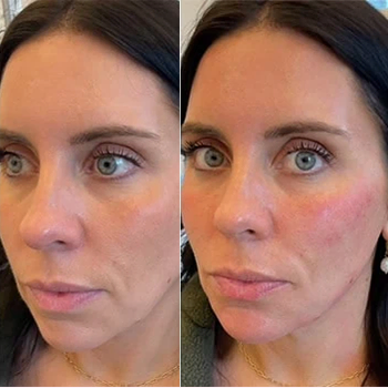 Dermal Fillers in Wilmington, NC | United Medical & Aesthetics
