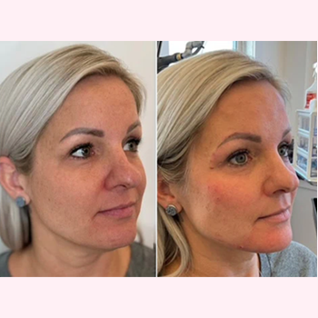 Dermal Fillers in Wilmington, NC | United Medical & Aesthetics