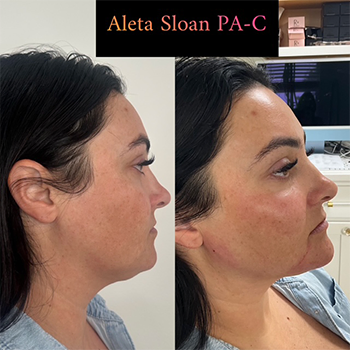 Dermal Fillers in Wilmington, NC | United Medical & Aesthetics