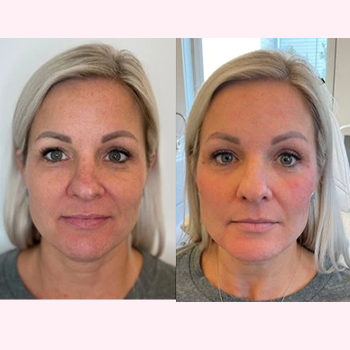 Dermal Fillers in Wilmington, NC | United Medical & Aesthetics