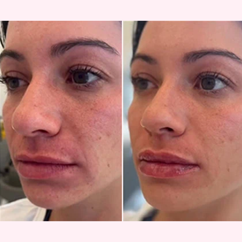 Dermal Fillers in Wilmington, NC | United Medical & Aesthetics