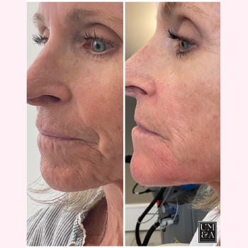 Dermal Fillers in Wilmington, NC | United Medical & Aesthetics