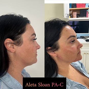 Dermal Fillers in Wilmington, NC | United Medical & Aesthetics