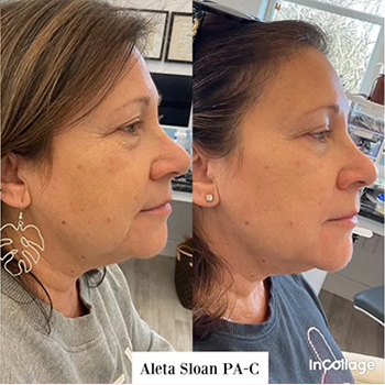 Dermal Fillers in Wilmington, NC | United Medical & Aesthetics