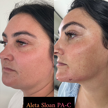 Dermal Fillers in Wilmington, NC | United Medical & Aesthetics