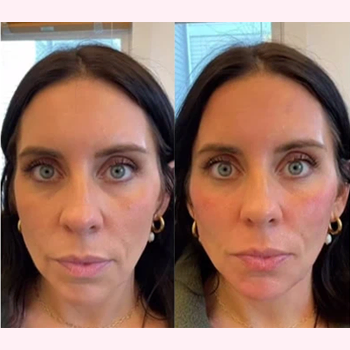 Dermal Fillers in Wilmington, NC | United Medical & Aesthetics