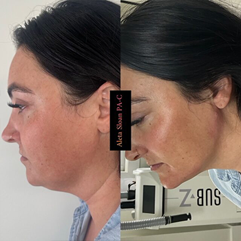 Dermal Fillers in Wilmington, NC | United Medical & Aesthetics