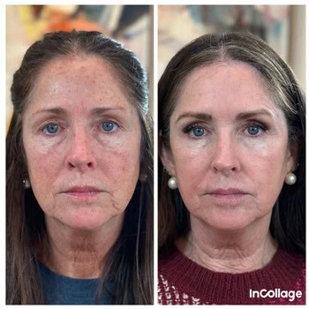 Helix in Wilmington, NC | United Medical & Aesthetics