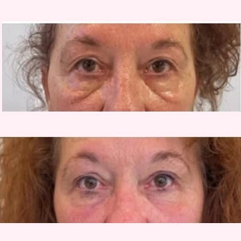 Helix in Wilmington, NC | United Medical & Aesthetics