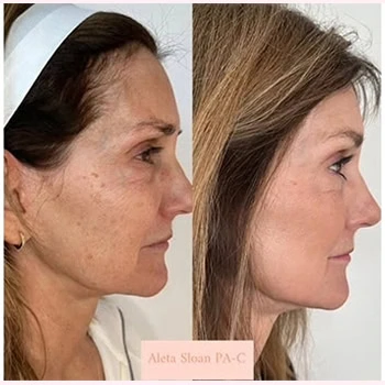 Helix in Wilmington, NC | United Medical & Aesthetics