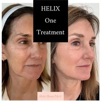 Helix in Wilmington, NC | United Medical & Aesthetics
