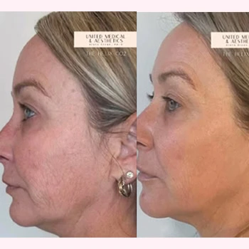 Helix in Wilmington, NC | United Medical & Aesthetics