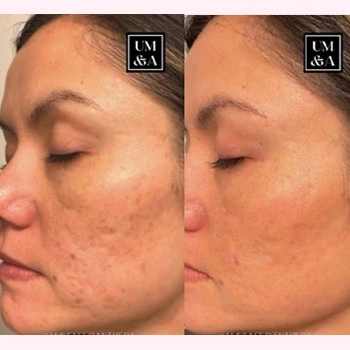 Helix in Wilmington, NC | United Medical & Aesthetics