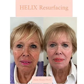 Helix in Wilmington, NC | United Medical & Aesthetics