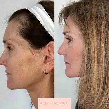 Helix in Wilmington, NC | United Medical & Aesthetics