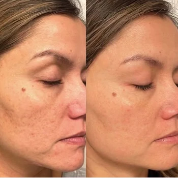 Helix in Wilmington, NC | United Medical & Aesthetics