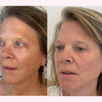 Helix in Wilmington, NC | United Medical & Aesthetics