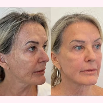 Helix in Wilmington, NC | United Medical & Aesthetics