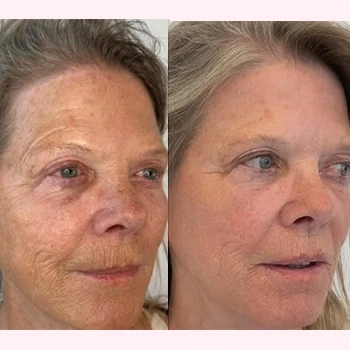 Helix in Wilmington, NC | United Medical & Aesthetics