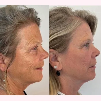 Helix in Wilmington, NC | United Medical & Aesthetics