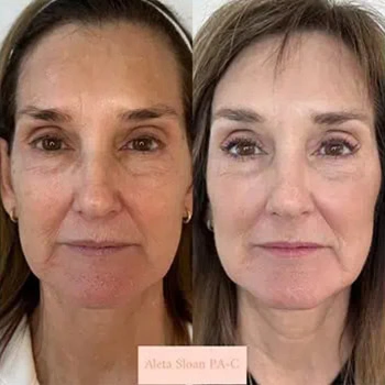 Helix in Wilmington, NC | United Medical & Aesthetics