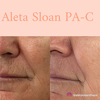 Expert Lip Line Treatment in Wilmington, NC