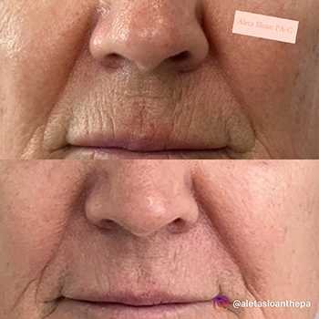 Expert Lip Line Treatment in Wilmington, NC