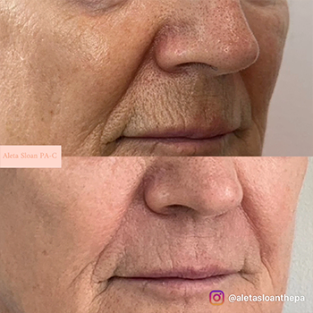 Expert Lip Line Treatment in Wilmington, NC